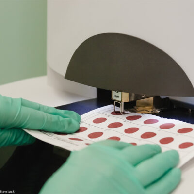 Newborn blood samples being prepared for analysis.